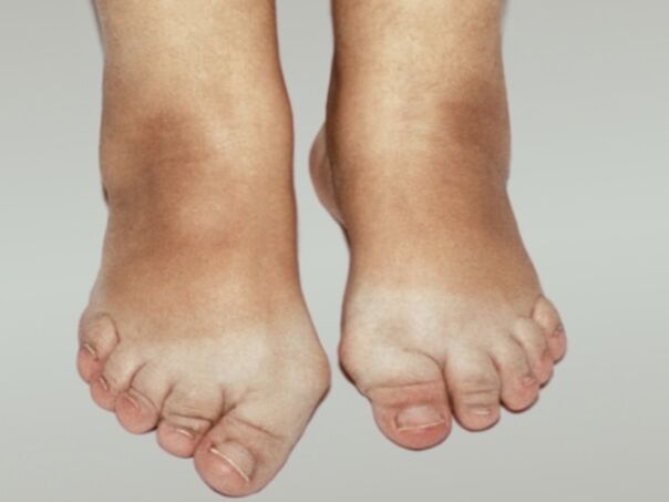 Osteoarthritis of the foot with severe deformation of the fingers