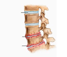 Osteocondrosis