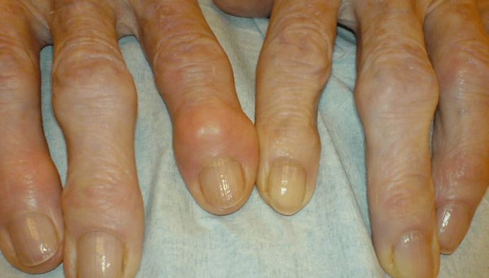 Pain in the joints of the fingers with osteoarthritis