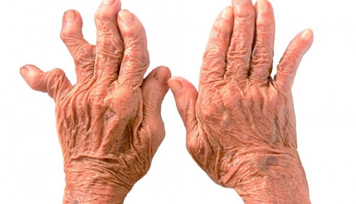 Rheumatoid arthritis as a cause of pain in the joints of the fingers