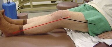 Progressive arthrobis of knee joint