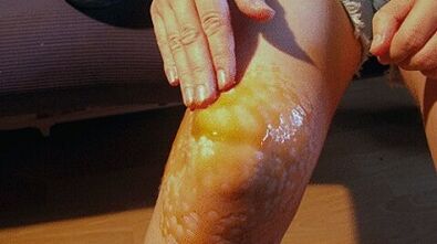Sages to treat arthrosis of knee combination