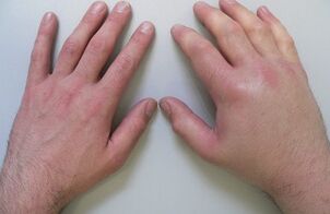 arthralgia, which causes pain in the joints of the fingers