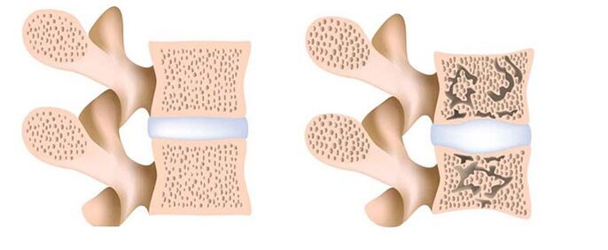 Osteoporosis - the removal of calcium from the bones