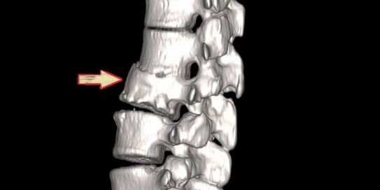 Spinal pathology as a cause of back pain