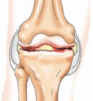 Vospaleniya tendons of the knee