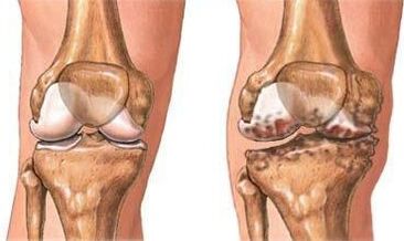 Arthaz of the knee