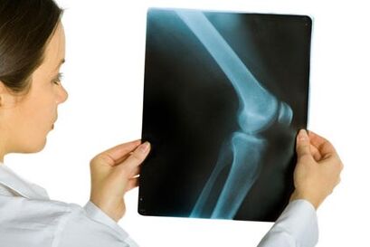 Treatment of arthrosis of knee combination