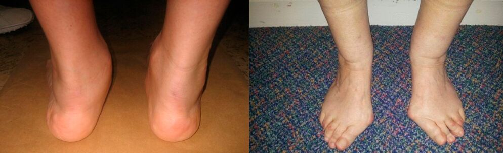 Osteoarthritis of the big toe and deforming arthrosis of the ankle