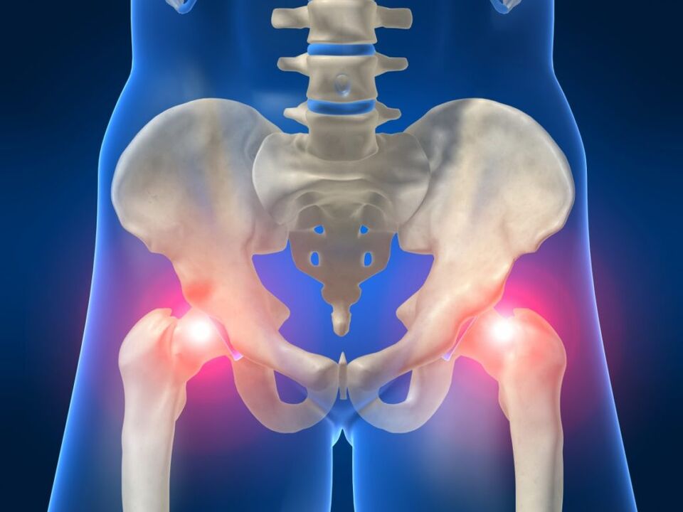 Ankylosing spondylitis is characterized by bilateral pain in the hip joint