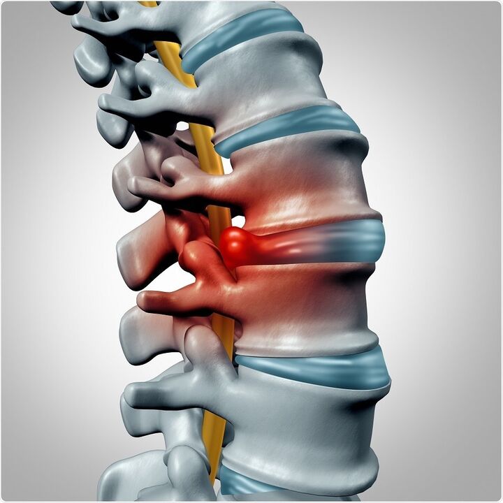 Disk deformity